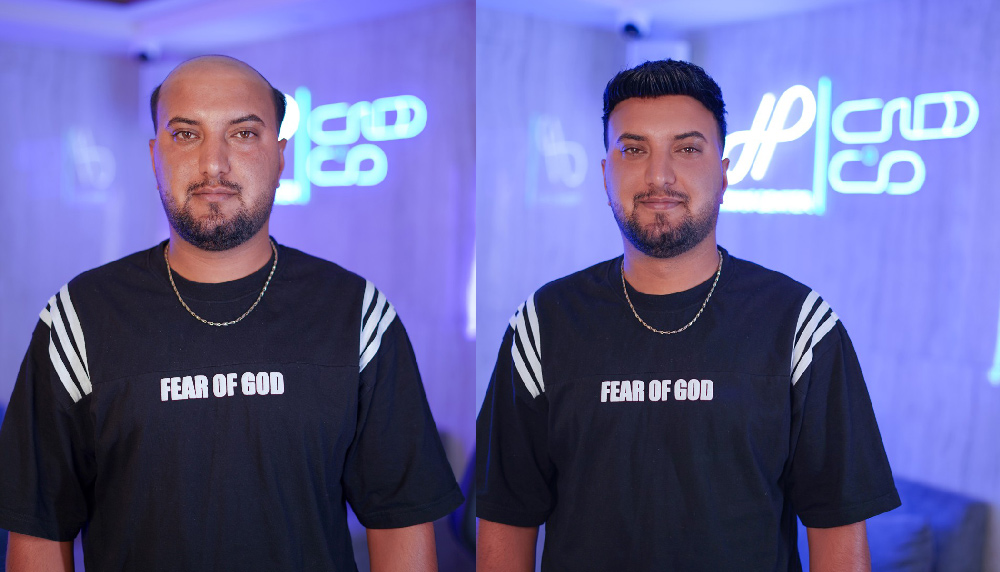 پروتز موی طبیعی مردانه اصفهان