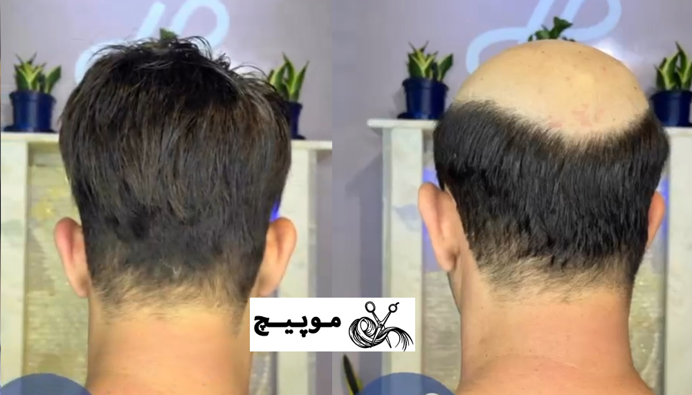 مرکز پروتز موی طبیعی در اصفهان